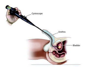 cystoskopia facet