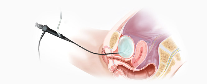 cystoskopia